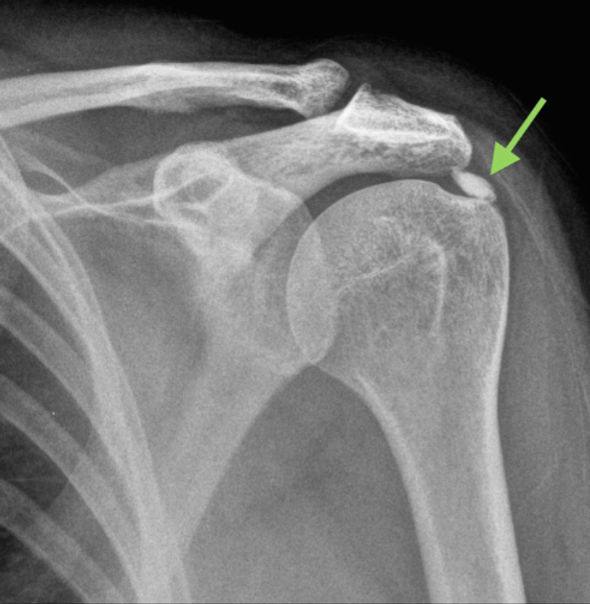 calcificazione di spalla