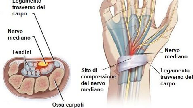 Sindrome del tunnel carpale (spiegazione)