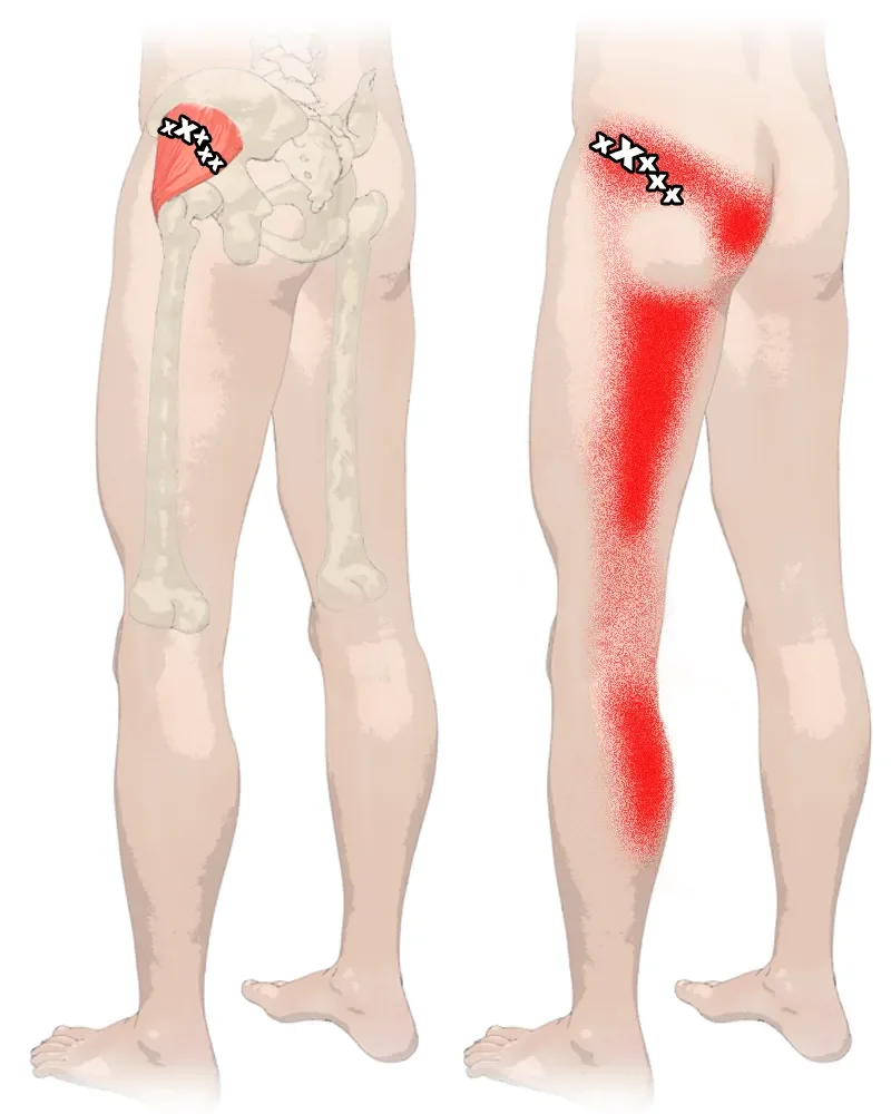 Sindrome del piriforme